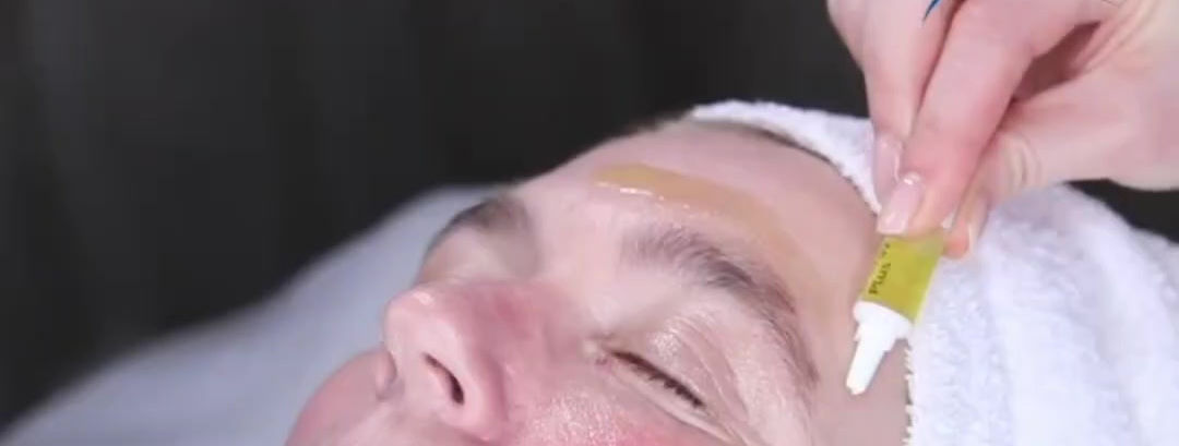 RF Micro Needling