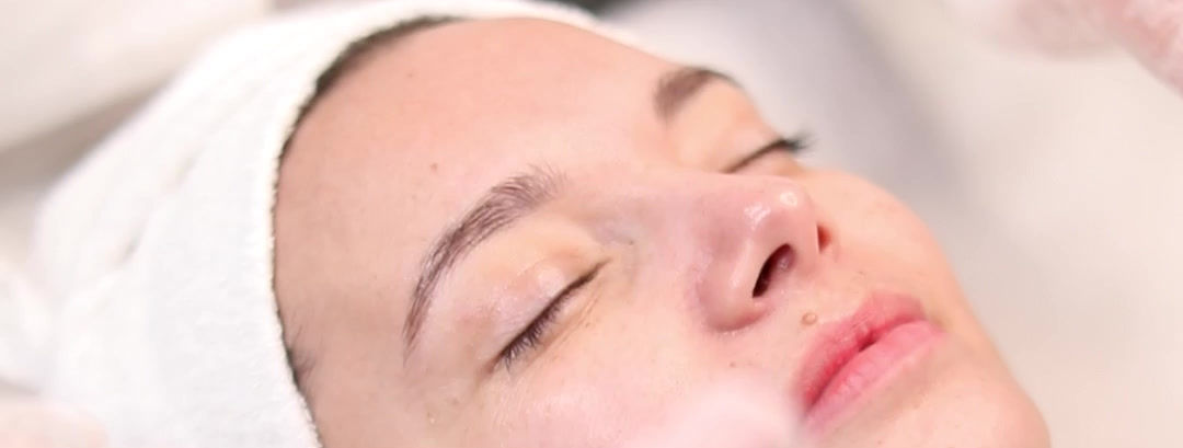 Micro Needling